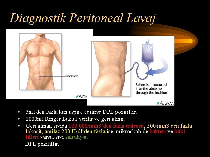 Diagnostik Peritoneal Lavaj • 5 ml den fazla kan aspire edilirse DPL pozitiftir. • Diagnostik Peritoneal Lavaj • 5 ml den fazla kan aspire edilirse DPL pozitiftir. •