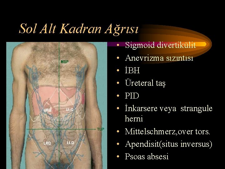 Sol Alt Kadran Ağrısı • • • Sigmoid divertikülit Anevrizma sızıntısı İBH Üreteral taş Sol Alt Kadran Ağrısı • • • Sigmoid divertikülit Anevrizma sızıntısı İBH Üreteral taş