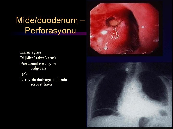 Mide/duodenum – Perforasyonu Karın ağrısı Rijidite( tahta karın) Peritoneal irritasyon bulguları şok X-ray de Mide/duodenum – Perforasyonu Karın ağrısı Rijidite( tahta karın) Peritoneal irritasyon bulguları şok X-ray de