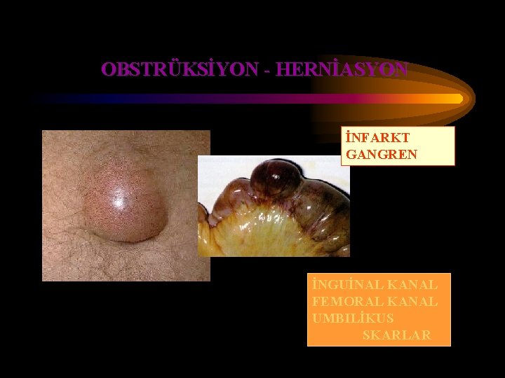 OBSTRÜKSİYON - HERNİASYON İNFARKT GANGREN İNGUİNAL KANAL FEMORAL KANAL UMBILİKUS SKARLAR OBSTRÜKSİYON - HERNİASYON İNFARKT GANGREN İNGUİNAL KANAL FEMORAL KANAL UMBILİKUS SKARLAR