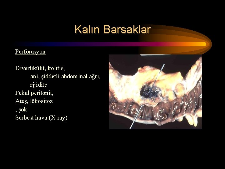 Kalın Barsaklar Perforasyon Divertikülit, kolitis, ani, şiddetli abdominal ağrı, rijidite Fekal peritonit, Ateş, lökositoz Kalın Barsaklar Perforasyon Divertikülit, kolitis, ani, şiddetli abdominal ağrı, rijidite Fekal peritonit, Ateş, lökositoz