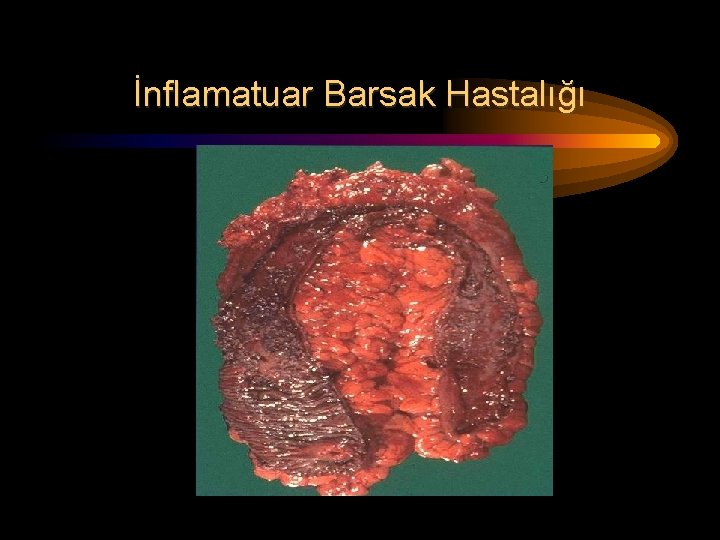 İnflamatuar Barsak Hastalığı 