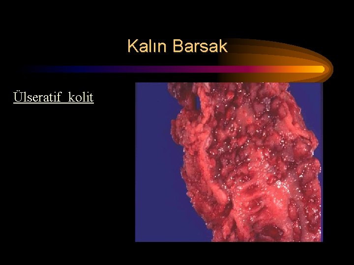 Kalın Barsak Ülseratif kolit Kalın Barsak Ülseratif kolit