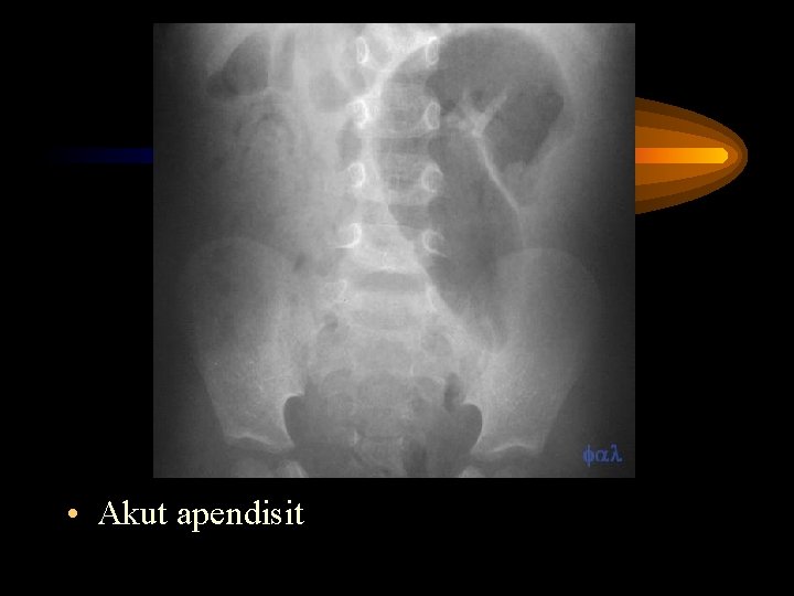 • Akut apendisit • Akut apendisit
