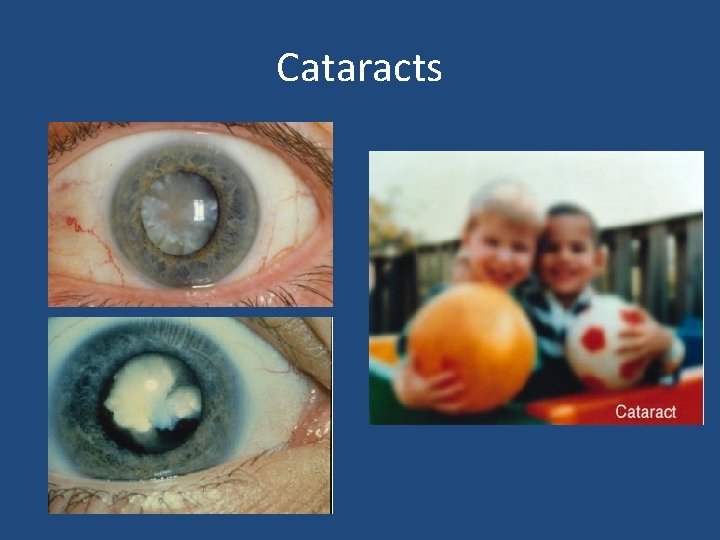 Cataracts Cataracts