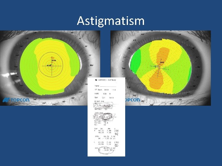 Astigmatism Astigmatism