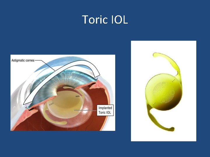 Toric IOL Toric IOL
