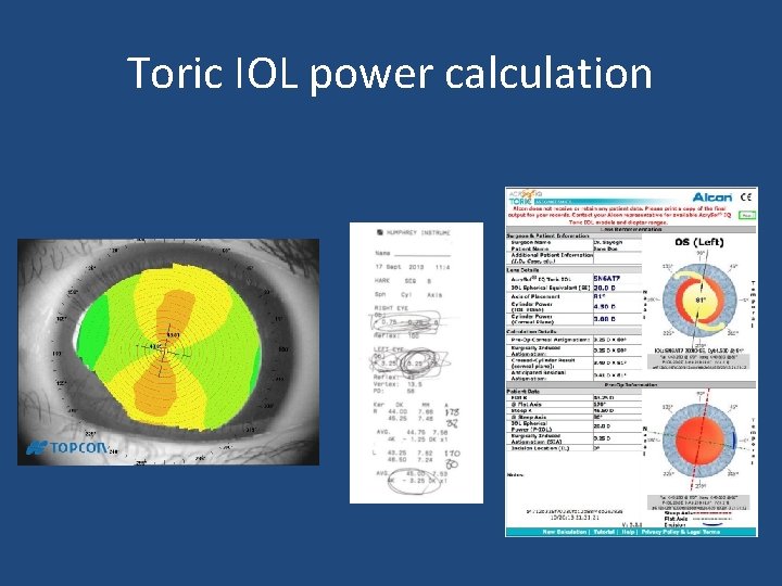 Toric IOL power calculation Toric IOL power calculation