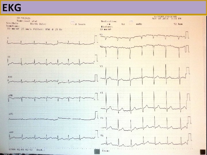 EKG 