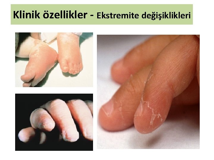 Klinik özellikler - Ekstremite değişiklikleri 