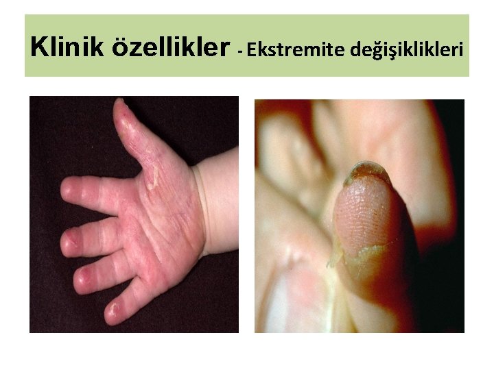Klinik özellikler - Ekstremite değişiklikleri 