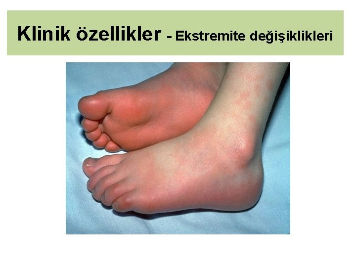 Klinik özellikler - Ekstremite değişiklikleri 