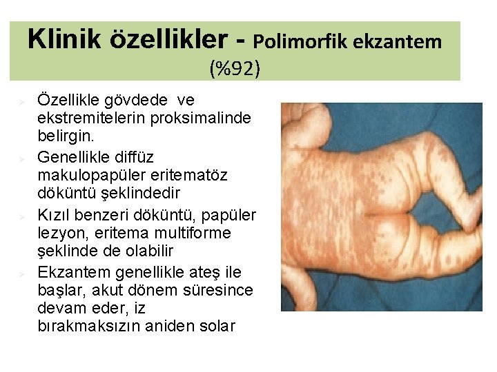 Klinik özellikler - Polimorfik ekzantem (%92) Ø Ø Özellikle gövdede ve ekstremitelerin proksimalinde belirgin.