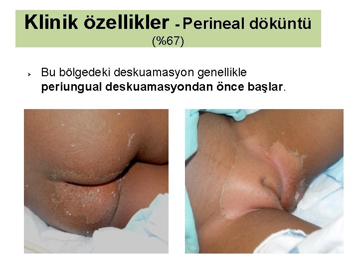 Klinik özellikler - Perineal döküntü (%67) Ø Bu bölgedeki deskuamasyon genellikle periungual deskuamasyondan önce