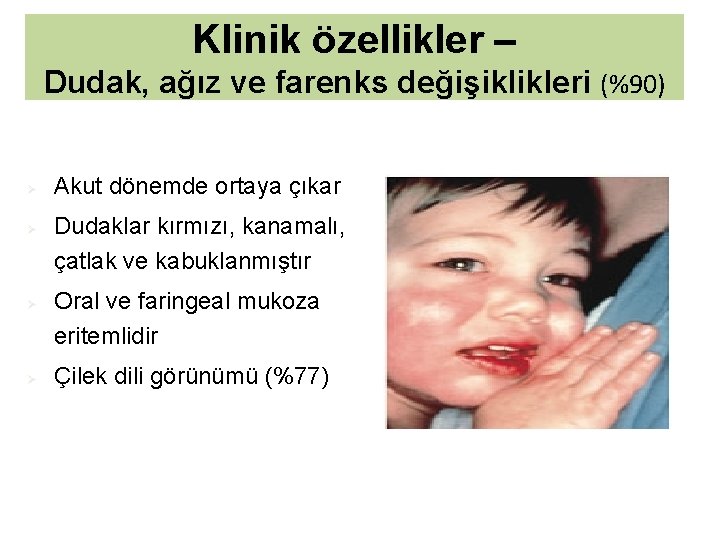Klinik özellikler – Dudak, ağız ve farenks değişiklikleri (%90) Ø Ø Akut dönemde ortaya
