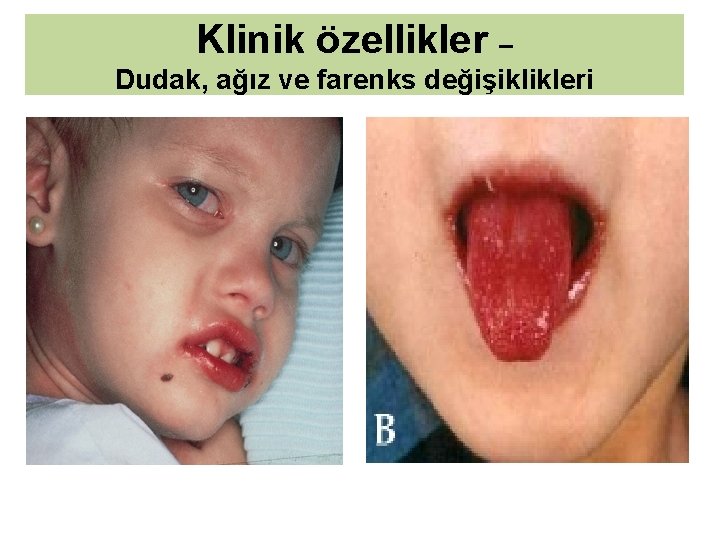 Klinik özellikler – Dudak, ağız ve farenks değişiklikleri 