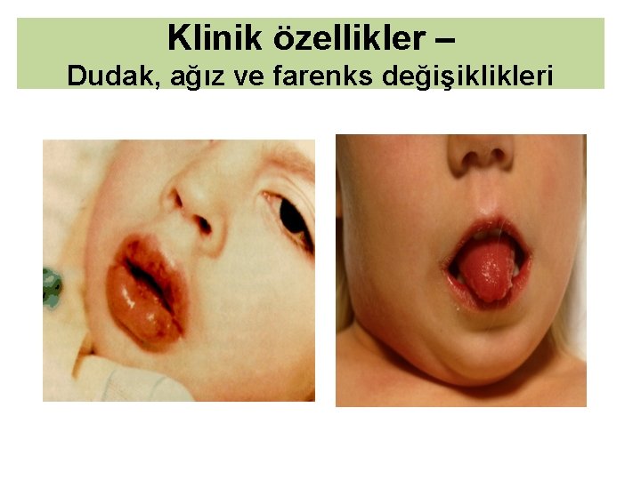 Klinik özellikler – Dudak, ağız ve farenks değişiklikleri 