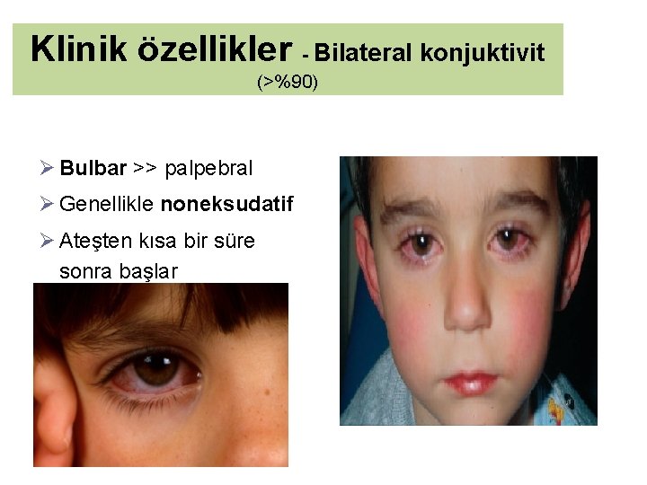 Klinik özellikler - Bilateral konjuktivit (>%90) Ø Bulbar >> palpebral Ø Genellikle noneksudatif Ø
