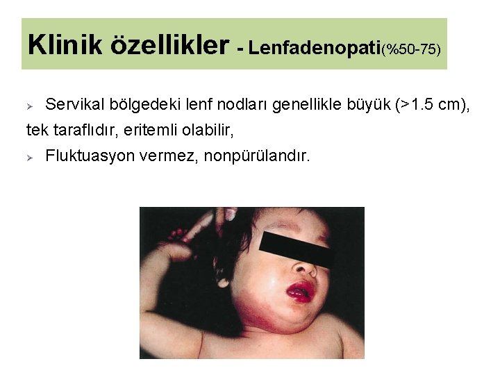 Klinik özellikler - Lenfadenopati(%50 -75) Ø Servikal bölgedeki lenf nodları genellikle büyük (>1. 5