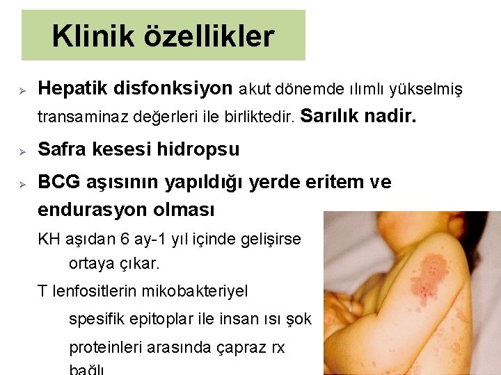 Klinik özellikler Ø Ø Ø Hepatik disfonksiyon akut dönemde ılımlı yükselmiş transaminaz değerleri ile
