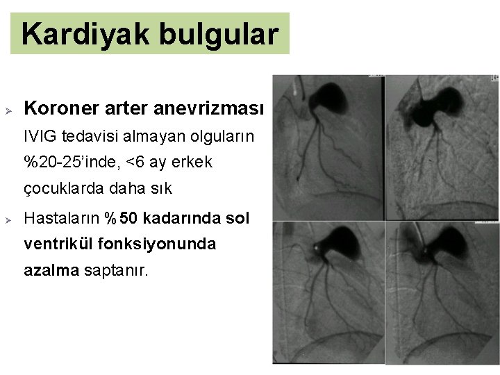 Kardiyak bulgular Ø Koroner arter anevrizması IVIG tedavisi almayan olguların %20 -25’inde, <6 ay