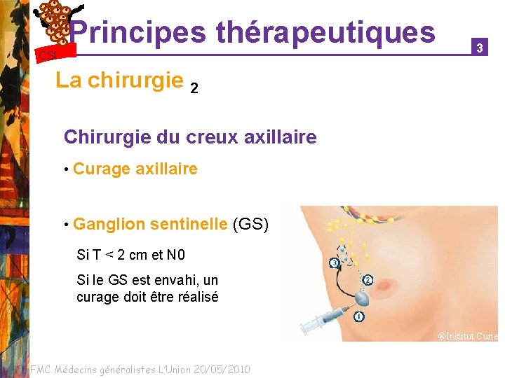 Principes thérapeutiques CSI 3 La chirurgie 2 Chirurgie du creux axillaire • Curage axillaire