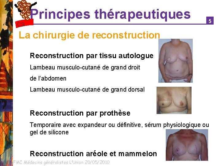 Principes thérapeutiques CSI 5 La chirurgie de reconstruction Reconstruction par tissu autologue Lambeau musculo-cutané