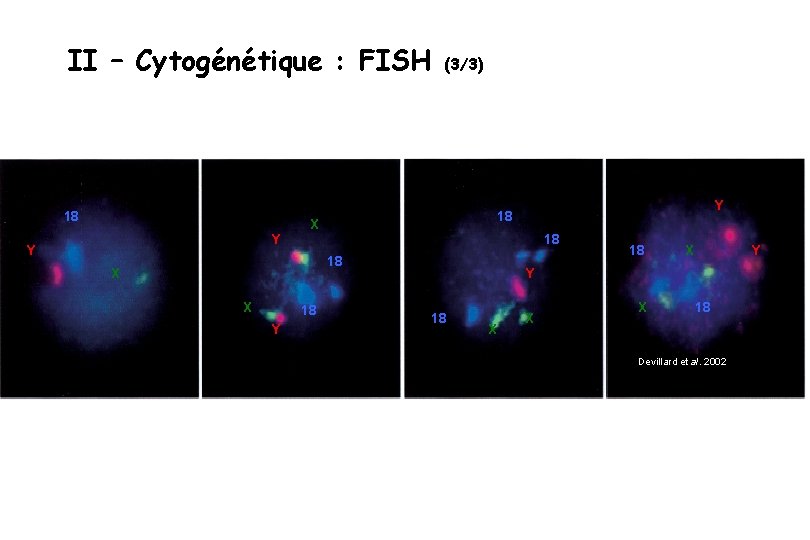 II – Cytogénétique : FISH 18 Y Y (3/3) X 18 18 X X