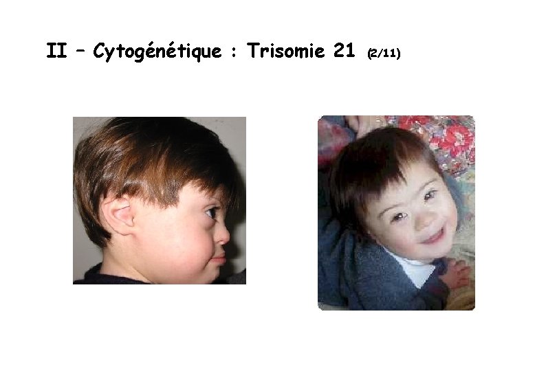 II – Cytogénétique : Trisomie 21 (2/11) 