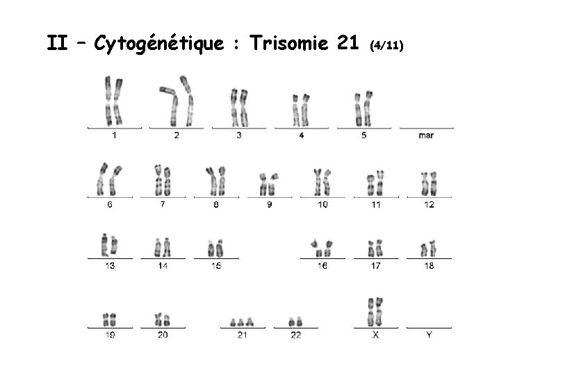 II – Cytogénétique : Trisomie 21 (4/11) 