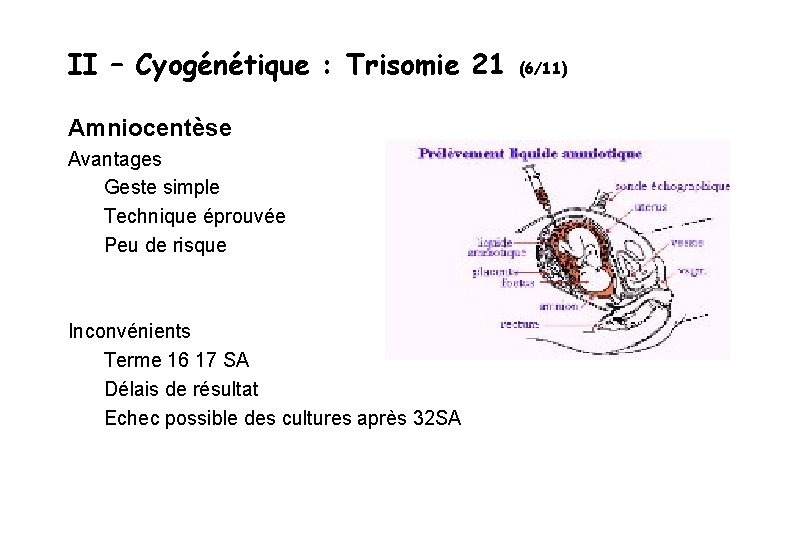 II – Cyogénétique : Trisomie 21 Amniocentèse Avantages Geste simple Technique éprouvée Peu de