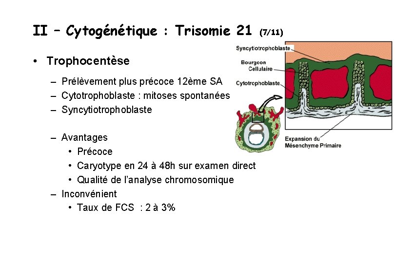 II – Cytogénétique : Trisomie 21 • Trophocentèse – Prélèvement plus précoce 12ème SA