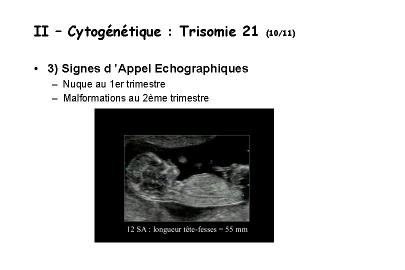 II – Cytogénétique : Trisomie 21 • 3) Signes d ’Appel Echographiques – Nuque