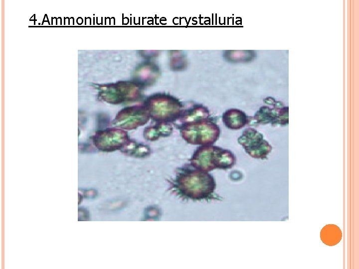 4. Ammonium biurate crystalluria 