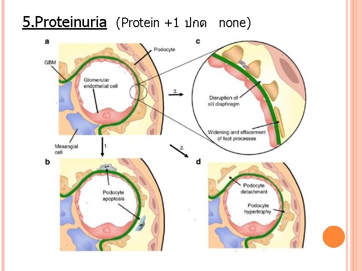 5. Proteinuria (Protein +1 ปกต none) 