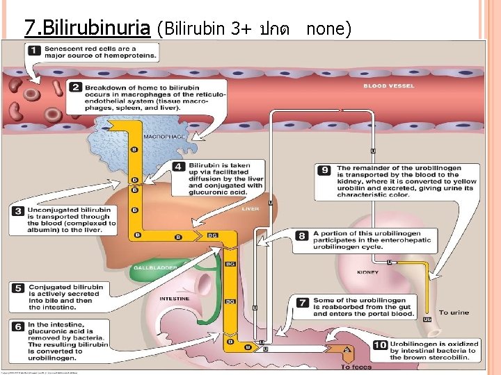 7. Bilirubinuria (Bilirubin 3+ ปกต none) 