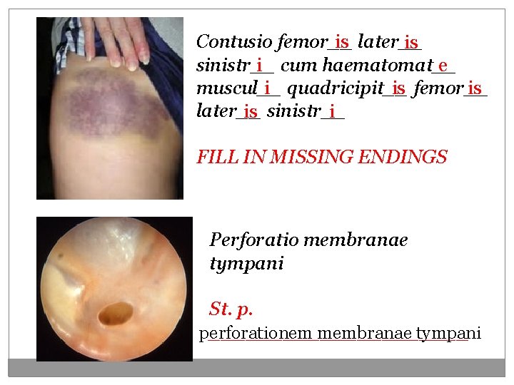 Contusio femor__ is later__ is sinistr__ i cum haematomat__ e muscul__ i quadricipit__ is Contusio femor__ is later__ is sinistr__ i cum haematomat__ e muscul__ i quadricipit__ is