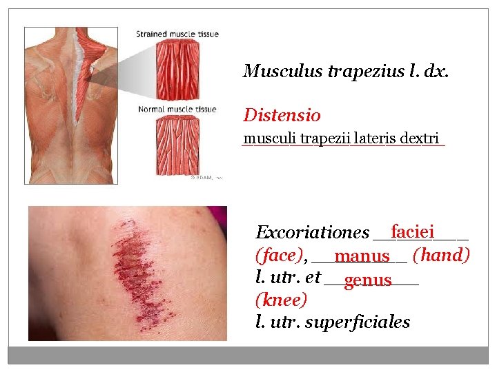 Musculus trapezius l. dx. Distensio musculi trapezii lateris dextri _________ faciei Excoriationes ____ (face), Musculus trapezius l. dx. Distensio musculi trapezii lateris dextri _________ faciei Excoriationes ____ (face),