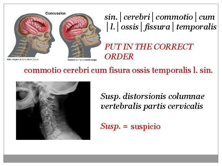 sin. │cerebri│commotio│cum │l. │ossis│fissura│temporalis PUT IN THE CORRECT ORDER commotio cerebri cum fisura ossis sin. │cerebri│commotio│cum │l. │ossis│fissura│temporalis PUT IN THE CORRECT ORDER commotio cerebri cum fisura ossis