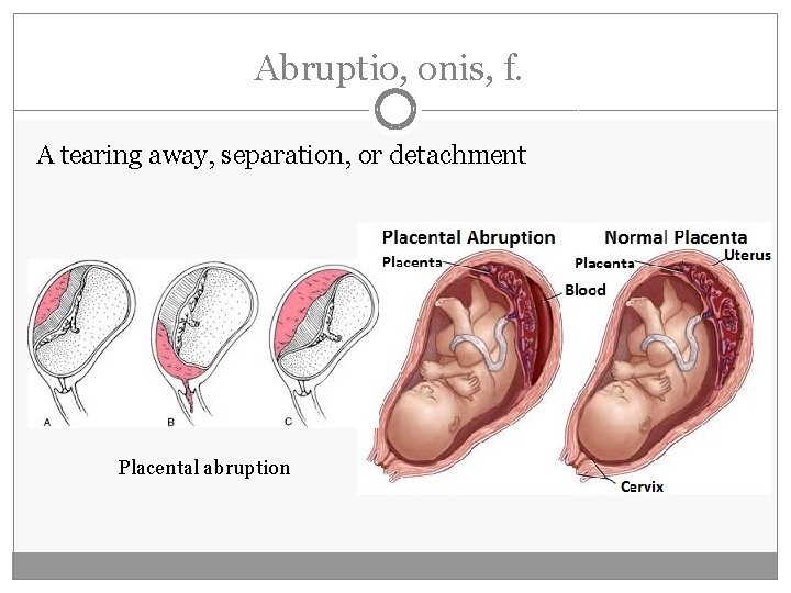 Abruptio, onis, f. A tearing away, separation, or detachment Placental abruption Abruptio, onis, f. A tearing away, separation, or detachment Placental abruption