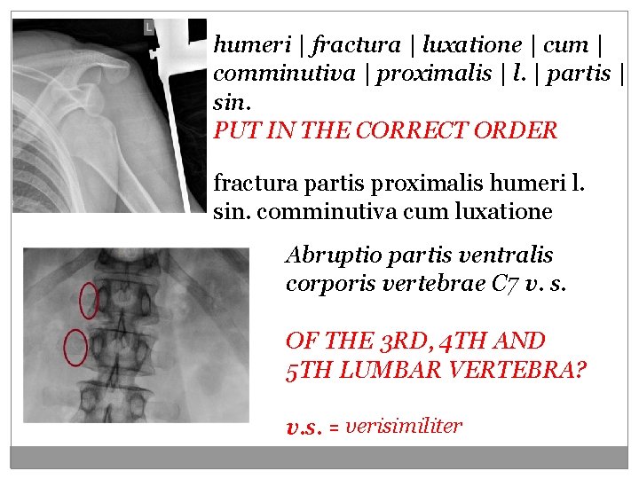 humeri | fractura | luxatione | cum | comminutiva | proximalis | l. | humeri | fractura | luxatione | cum | comminutiva | proximalis | l. |