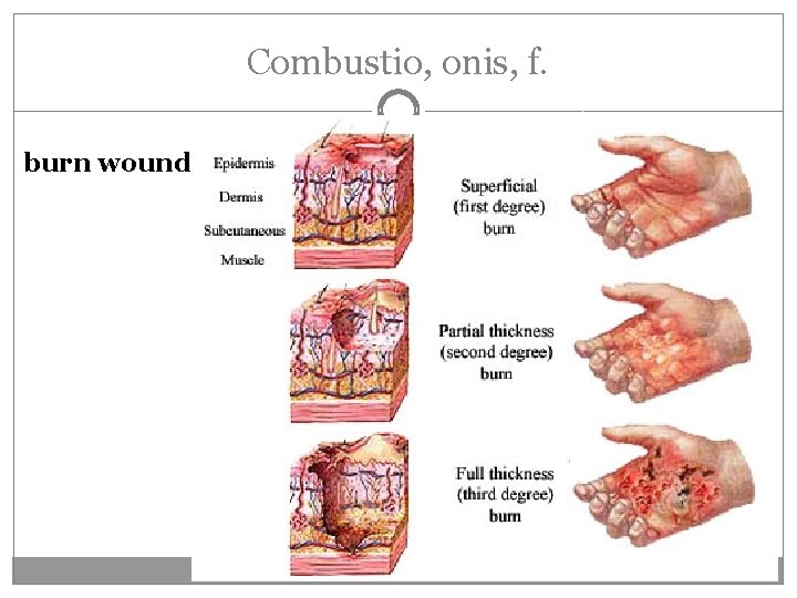 Combustio, onis, f. burn wound Combustio, onis, f. burn wound