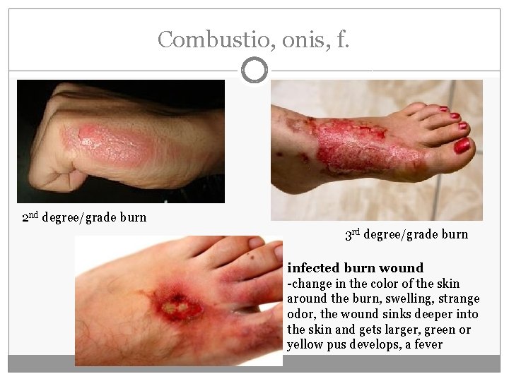 Combustio, onis, f. 2 nd degree/grade burn 3 rd degree/grade burn infected burn wound Combustio, onis, f. 2 nd degree/grade burn 3 rd degree/grade burn infected burn wound