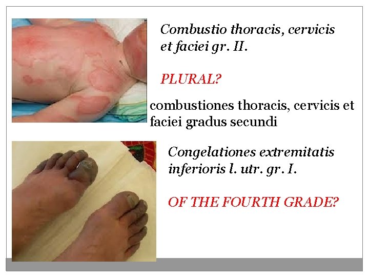 Combustio thoracis, cervicis et faciei gr. II. PLURAL? combustiones thoracis, cervicis et faciei gradus Combustio thoracis, cervicis et faciei gr. II. PLURAL? combustiones thoracis, cervicis et faciei gradus