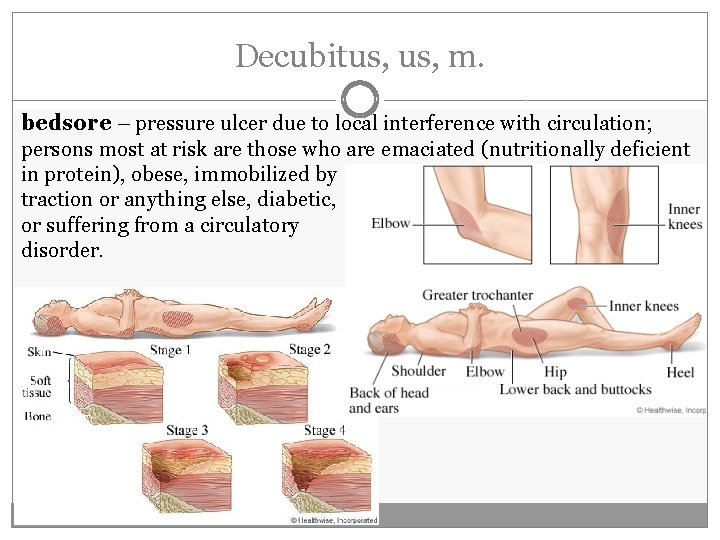 Decubitus, m. bedsore – pressure ulcer due to local interference with circulation; persons most Decubitus, m. bedsore – pressure ulcer due to local interference with circulation; persons most