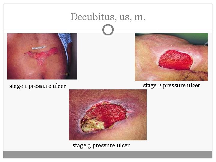 Decubitus, m. stage 2 pressure ulcer stage 1 pressure ulcer stage 3 pressure ulcer Decubitus, m. stage 2 pressure ulcer stage 1 pressure ulcer stage 3 pressure ulcer
