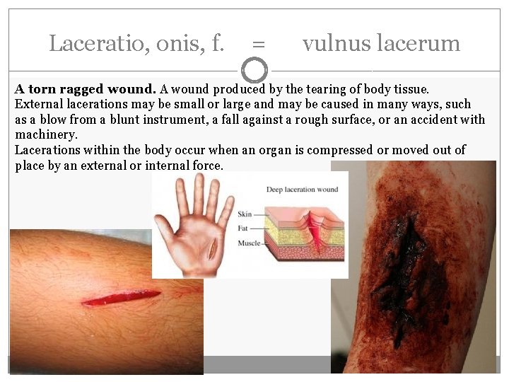 Laceratio, onis, f. = vulnus lacerum A torn ragged wound. A wound produced by Laceratio, onis, f. = vulnus lacerum A torn ragged wound. A wound produced by