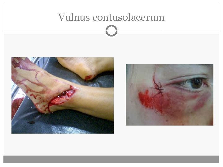Vulnus contusolacerum Vulnus contusolacerum