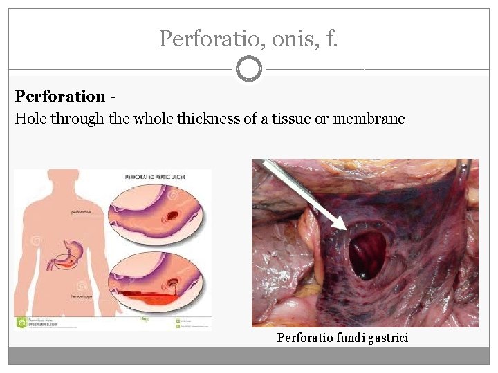 Perforatio, onis, f. Perforation Hole through the whole thickness of a tissue or membrane Perforatio, onis, f. Perforation Hole through the whole thickness of a tissue or membrane