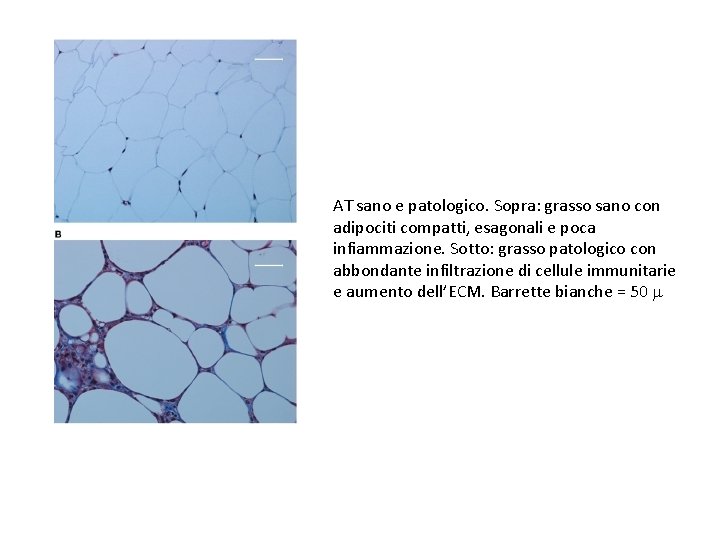 AT sano e patologico. Sopra: grasso sano con adipociti compatti, esagonali e poca infiammazione.